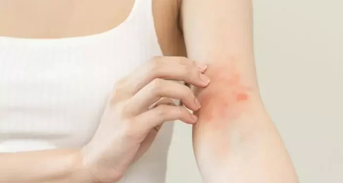 Veja 6 doenças de pele agravadas no inverno e como evitar crises