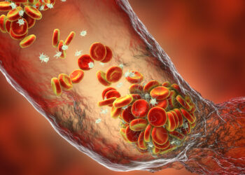 Dia Mundial da Trombose: doença requer prevenção constante