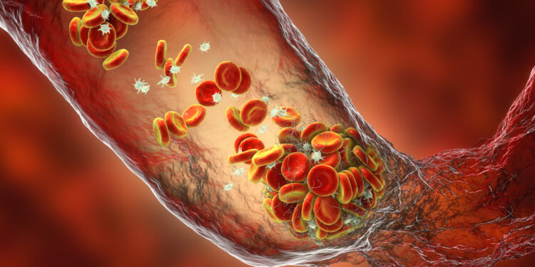 Dia Mundial da Trombose: doença requer prevenção constante