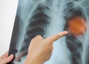 Pneumonia: vacinação é a principal forma de prevenção