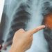 Pneumonia: vacinação é a principal forma de prevenção