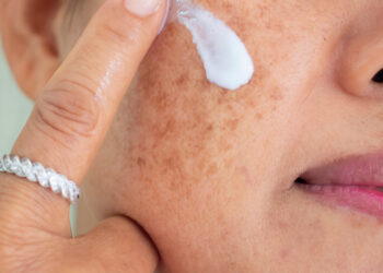 Melasma: conheça as causas, tratamento e prevenção