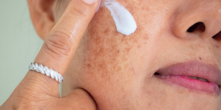 Melasma: conheça as causas, tratamento e prevenção