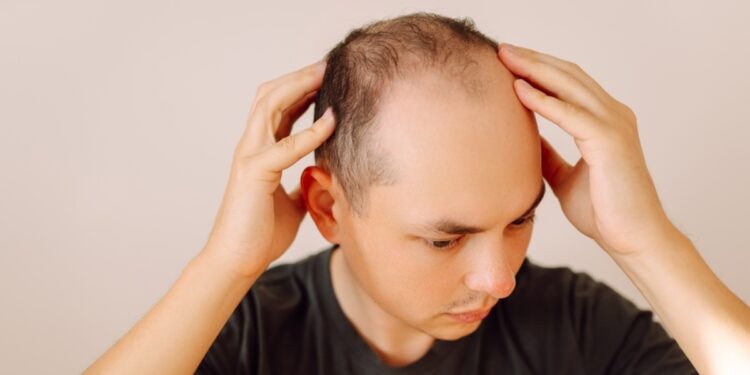 Fim dos carecas? Cientistas criam produto que faz o cabelo voltar a crescer