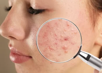 Acne: o que é, sintomas, causas e tratamento