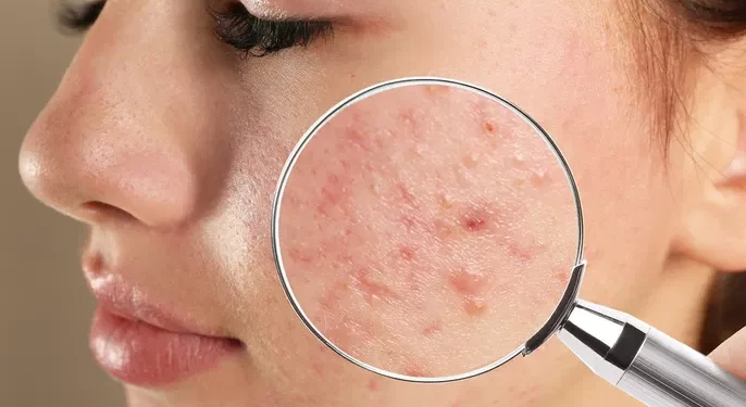 Acne: o que é, sintomas, causas e tratamento