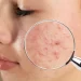 Acne: o que é, sintomas, causas e tratamento