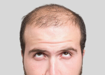 Conheça as causas mais comuns da queda de cabelo