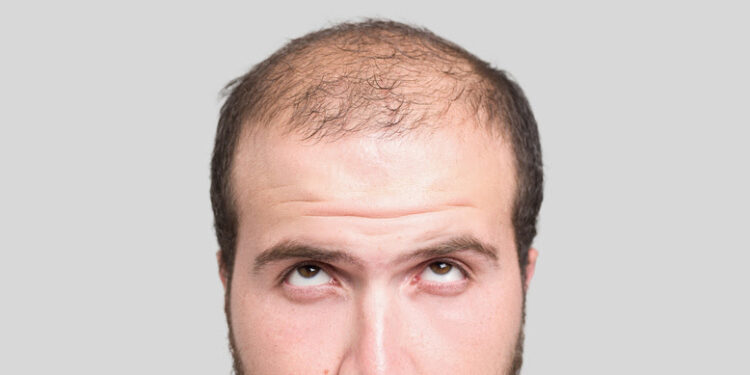 Conheça as causas mais comuns da queda de cabelo