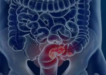 Estudo projeta aumento de 36% em mortes por câncer colorretal até 2040