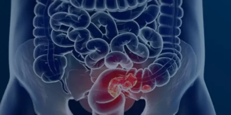 Estudo projeta aumento de 36% em mortes por câncer colorretal até 2040