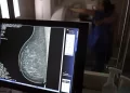 Ministério da Saúde passa a recomendar mamografia a partir dos 40 anos