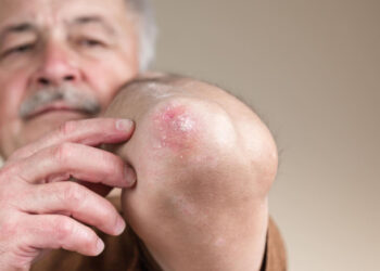 No SUS: Portaria inclui farmacêuticos no cuidado à hanseníase