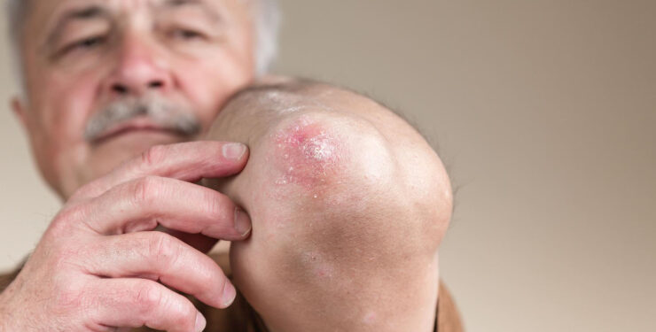 No SUS: Portaria inclui farmacêuticos no cuidado à hanseníase