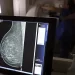 Falta de acesso a mamógrafos limita prevenção do câncer de mama