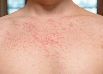 Brasil registra 34 casos de sarampo; Ministério da Saúde emite alerta