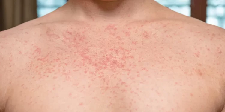 Brasil registra 34 casos de sarampo; Ministério da Saúde emite alerta