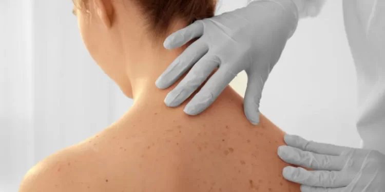 Dezembro Laranja reforça os cuidados contra o câncer de pele