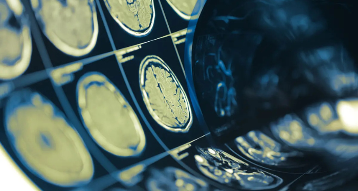 Nova molécula reduz em 26% segundo AVC, diz estudo da Bayer