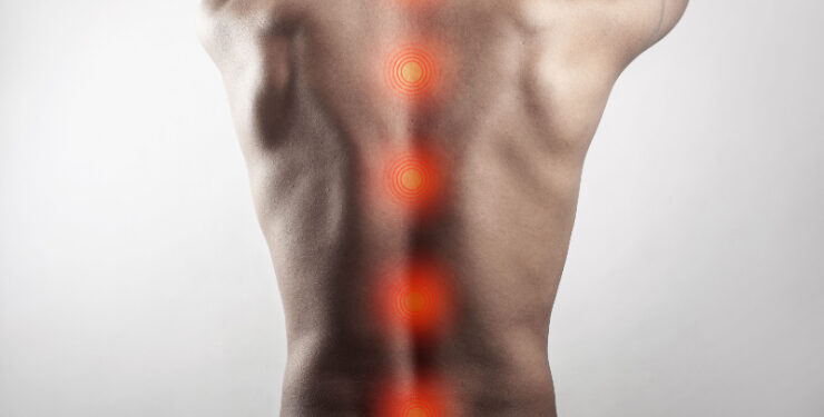 Polilaminina avança em testes clínicos e reacende expectativas no tratamento de lesões medulares