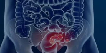 Mortes por câncer colorretal devem aumentar quase 3 vezes até 2030