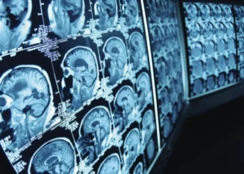Pesquisa de polipílula para prevenção do AVC busca 8,5 mil voluntários