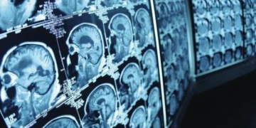 Pesquisa de polipílula para prevenção do AVC busca 8,5 mil voluntários