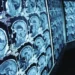 Pesquisa de polipílula para prevenção do AVC busca 8,5 mil voluntários