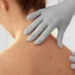 Moderna e Merck anunciam eficácia de vacina contra câncer de pele