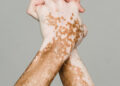 Novas terapias contra o vitiligo abrem caminho para tratamento mais eficaz e duradouro