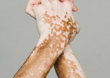 Novas terapias contra o vitiligo abrem caminho para tratamento mais eficaz e duradouro