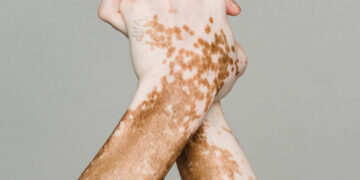 Novas terapias contra o vitiligo abrem caminho para tratamento mais eficaz e duradouro