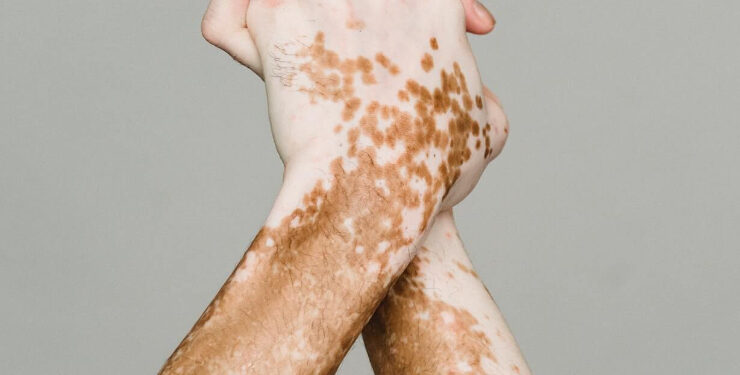 Novas terapias contra o vitiligo abrem caminho para tratamento mais eficaz e duradouro