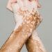 Novas terapias contra o vitiligo abrem caminho para tratamento mais eficaz e duradouro