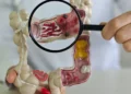 Em 13 anos, doença inflamatória intestinal cresce 5 vezes no Brasil