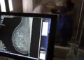 Médicos lançam guia para evitar recusa de mamografia digital