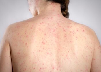 Negacionismo impulsiona sarampo nos EUA e representa ameaça ao Brasil