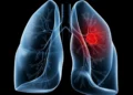 Saiba o que é adenocarcinoma pulmonar, câncer que atinge o papa